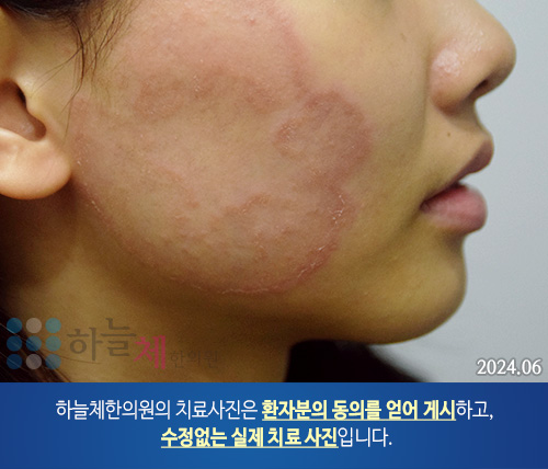 습진양 판상 병변 피부질환