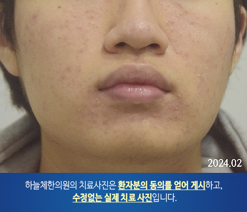  모낭염을 동반한 지루피부염 홍조