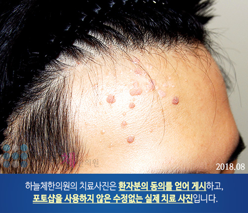 두드러기 치료